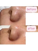 エミュ(emu)/◆毛穴・黒ずみ・皮脂テカリ