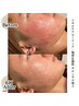【学割】皮膚科学発のニキビケア/赤ら顔改善ピーリング◎¥11000→¥8800