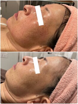 エステサロン ブレス 山形店(BLESS)/フェイシャル結果