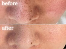 メモリ/お客様の変化/毛穴ケア