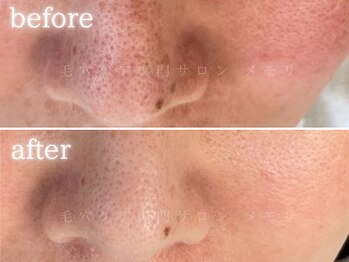 メモリ/お客様の変化/毛穴ケア
