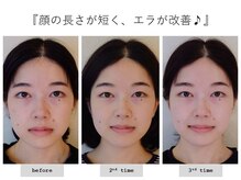 エピファニー(Epiphany)/歪み、エラ張り、首コリが悩みで