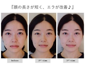 エピファニー(Epiphany)/歪み、エラ張り、首コリが悩みで