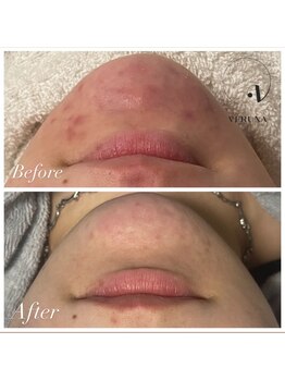 MMK/頑固なニキビケアにもハーブが◎