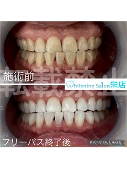 ホワイトニングサロン 名古屋 栄店/【ホワイトニング】