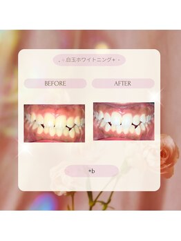 プラスビー 2号店(+b)/ホワイトニングビフォーアフター