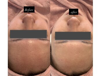 アミティエ 高田馬場店(Amitie)/毛穴洗浄×顔脱毛×美容液導入