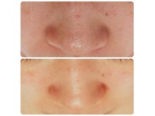 ハッピー(Happy)の雰囲気(【毛穴の黒ずみ・角栓】ツルンと!毛穴が目立たない肌に)