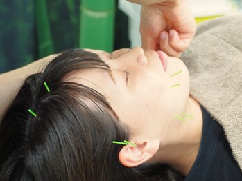 ひがし整骨院の写真/気になるお顔のたるみ・シワ・むくみに◎美容鍼でリフトアップケアしませんか？