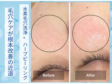 ブルーム(Bloom)/本気の肌質改善