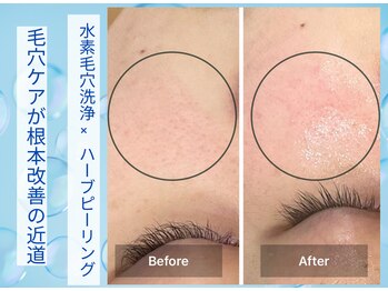 ブルーム(Bloom)/本気の肌質改善