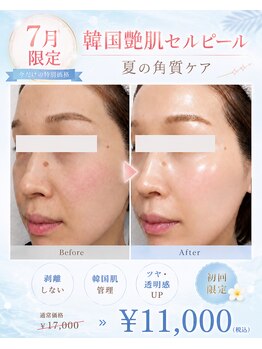 アルルプラス 南草津(ARuru+)/毛穴ごっそり洗浄ケア