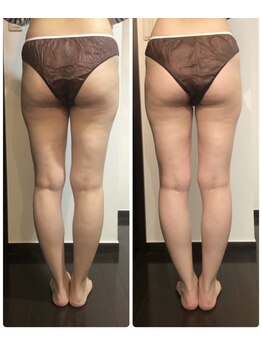 ベル エ スヌーズ(Bell et snooze)/下半身集中4回+ホームケア週3回