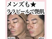 ホワイトアクア 池袋店(WHITE AQUA)/ララピール/毛穴洗浄/池袋