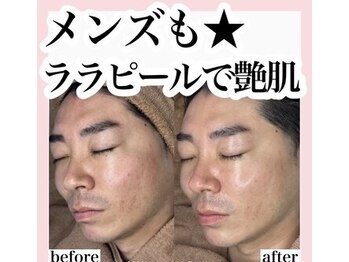 ホワイトアクア 池袋店(WHITE AQUA)/ララピール/毛穴洗浄/池袋