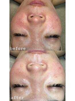 プラスボーテ 幡ヶ谷(plus beaute)/赤ら顔改善/青山/表参道/原宿