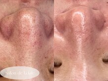 サロンドエクラル(Salon de Eclale wax)/＊毛穴洗浄×艶肌wax＊