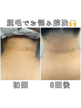 エヌプラス(N+)/20代女性＊脱毛8回後