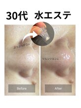 ヒール(heal)/鼻のざらつき