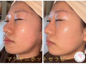 ジェミニ(Gemini)の写真/マツヤニワックス脱毛で産毛と角質をまるごと除去!光をまとったような水光肌・艶肌へ導く素肌リセットケア*