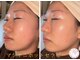 ジェミニ(Gemini)の写真/マツヤニワックス脱毛で産毛と角質をまるごと除去!光をまとったような水光肌・艶肌へ導く素肌リセットケア*