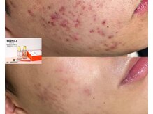 アミナス 渋谷店(AMINAS)/ハーブピーリングで毛穴レス美肌