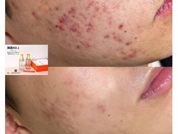 アミナス 渋谷店(AMINAS)/ハーブピーリングで毛穴レス美肌