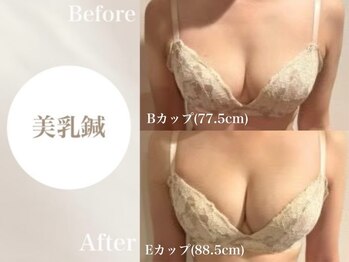 Onはり灸サロン/バストUP美乳鍼before→after