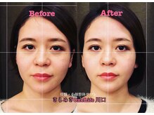 きらめき ワンライフ 川口(One Life)/小顔矯正BeforeAfter４