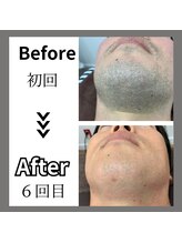 ミライキング(mirai king)/ビフォーアフター