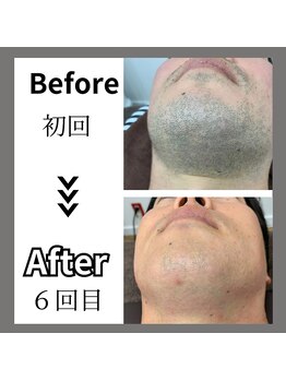 ミライキング(mirai king)/ビフォーアフター