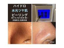 ピピ ギンザ(PiPi GINZA)の雰囲気（大人気★ハイドロピーリング導入しました毛穴洗浄顔or背中or頭皮）