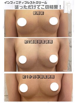 ベッピン(Beppin)/バストアップ症例写真