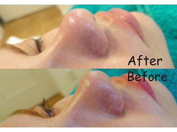 夏秋美肌サロン/毛穴洗浄+ワックス(部分)