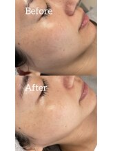 ルシェビューテイー(Luche Beauty)/毛穴撃退なのにフェイスライン？