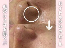 エン クリニカルラボ 心斎橋店(E&N CLINICAL LABO)の雰囲気（幹細胞ハーブピーリング＋ハイドラで毛穴、ニキビにアプローチ♪）