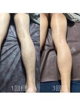 カナウ(KANAU)/足脱毛（20代前半男性）