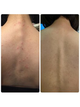 ソワン(Sowan)/背中ハ-ブピ-リングBefore/After