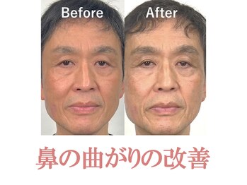 隆鼻矯正専門店 ラプリ(Raplit)/隆鼻＋輪郭矯正40分10回