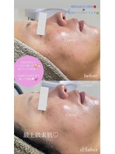 クレヴィー(Creviy)/3D毛穴洗浄×ハーブピーリング