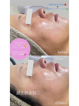 クレヴィー(Creviy)/3D毛穴洗浄×ハーブピーリング
