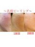 【ニキビ/毛穴でお悩みの方へ】ニキビケア＆艶肌☆乳酸ピーリング14000