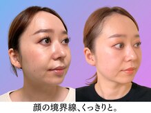 ナチュラルビューティーフェイス 横浜(NBF)/Before&After