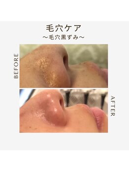 ツヤハダコガオ 千葉店/before⇒afterハイドロ毛穴洗浄