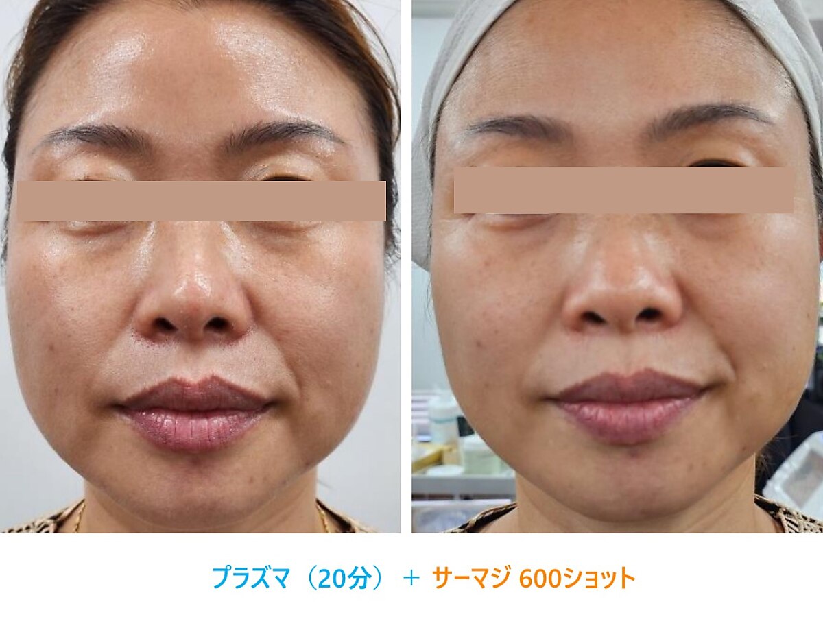 【大特価年末セール】剥離ありハーブピーリング50回分 数量限定】剥離ありハーブピーリング5回分 ハーブピーリング