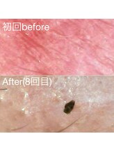 ミニョスキンラボ/韓国ハーブピーリング&ララ8回