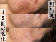 ビジュープラス 広島店(Bijou+)/【20代/凹凸肌】