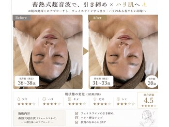 ビ フェイス(Bi-face)/蓄熱式超音波の効果