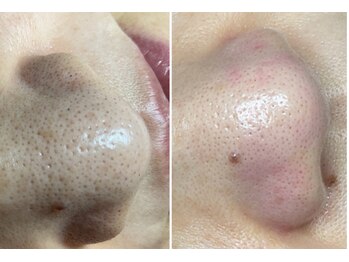 トータルビューティーサロン 凛/毛穴改善