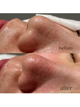 シャルム ド ケー(charme de k)/最強毛穴洗浄